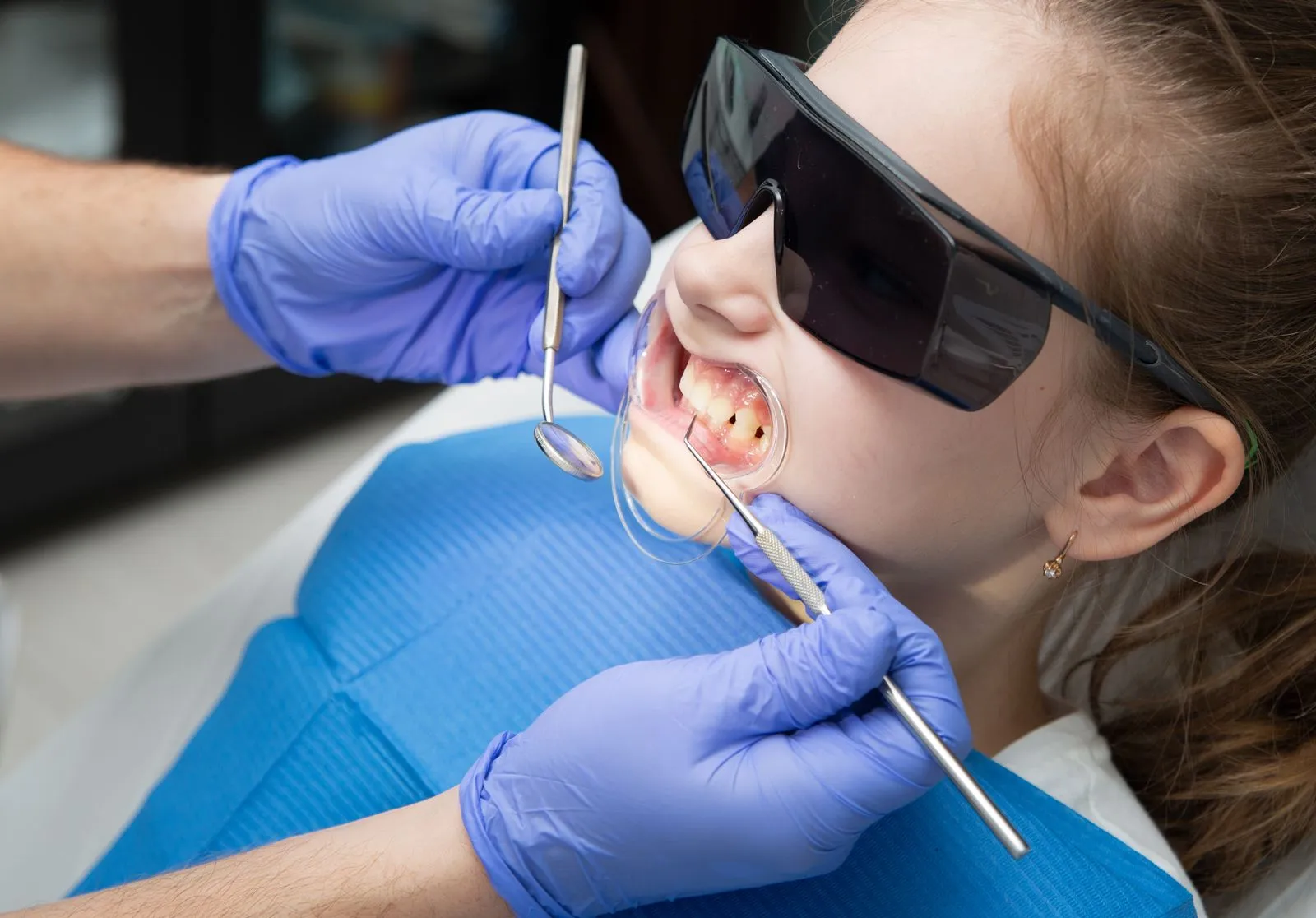 A child receiving dental care wearing protective goggles during treatment.